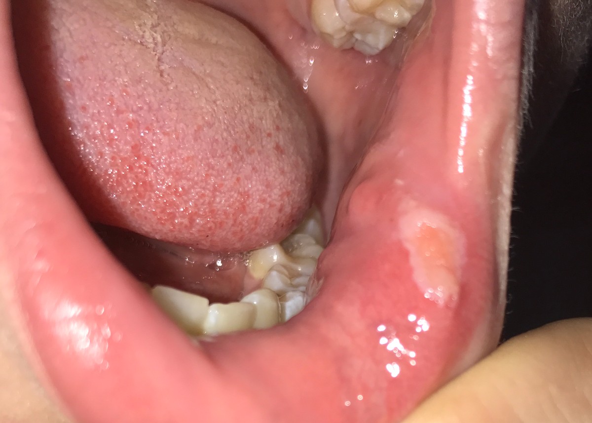 MOUTH INFECTION: एक दिन में मुंह के छाले गायब ! मुंह के छालों का घरेलू उपचार