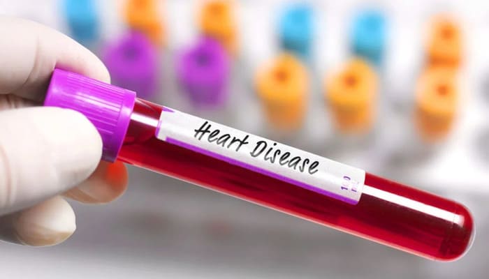 क्या होता है Lipoprotein(a) [Lp(a)] टेस्ट?